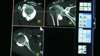 arthroscanner dépaule examen normal [upl. by Htebaras]