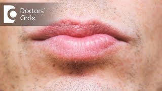 What causes discoloration below lip amp its management  Dr Sachith Abraham [upl. by Dazhehs425]