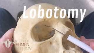 The Anatomy of a Lobotomy [upl. by Massarelli14]