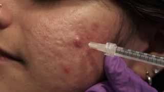 Watch amp Learn Intralesional injections [upl. by Addam]