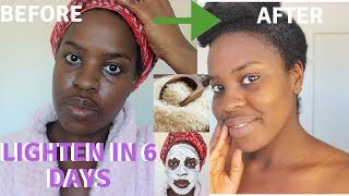 How I How i BRIGHTENED MY SKIN IN 6 DAYS REALISTIC and Natural way to reduce hyperpigmentation [upl. by Aceissej311]