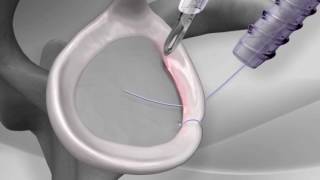 Knotless Shoulder Labral Repair with Arthrex® PushLock® [upl. by Ham289]