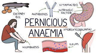 Understanding Pernicious Anaemia B12 Deficiency [upl. by Akirdnahs226]