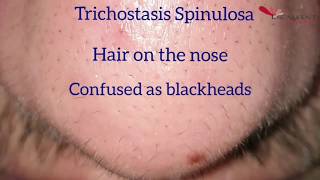 Hair removal on the nose by Laser  Trichostasis Spinulosa [upl. by Ridglea]