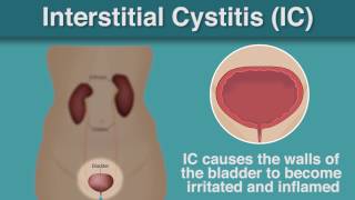 What Is  Interstitial Cystitis [upl. by Aiveneg]