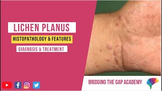 What is Lichen Planus Histopathology amp Features Diagnosis amp Treatment [upl. by Aremaj]