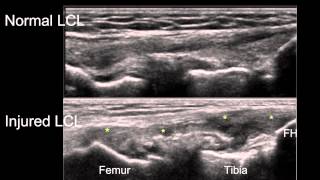 Sonographic Examination of Knee Ligaments [upl. by Hallee]