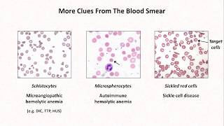 Anemia Lesson 4  Clues from the blood smear [upl. by Eliott441]