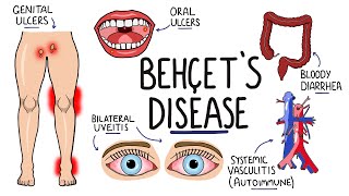 Anterior uveitis posterior uveitis and panuveitis etiology symptoms diagnosis and treatment [upl. by Killy801]