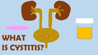 What is Cystitis [upl. by Kenweigh787]