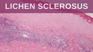 Lichen Sclerosus  Pathology mini tutorial [upl. by Nashbar]