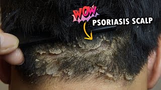 Wow Psoriasis Dry Scalp Scratching So Much Dandruff Removal Satisfying 363 [upl. by Seline203]