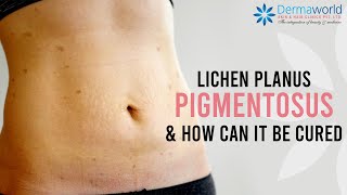 How to cure Lichen Planus Pigmentosus  Lichen Planus Pigmentosus Treatment  Dr Rohit Batra [upl. by Lerim616]