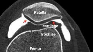 Chondropathierotule3D Arthroscanner [upl. by Notlimah]