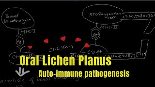 Oral Lichen Planus  Pathogenesis Nepali  Oral Pathology  Dentophile [upl. by Hermann]