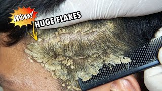 Huge Dandruff Flakes Removing and Picking 635 [upl. by Faires]